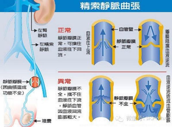 關(guān)于2021年征兵精索靜脈曲張標(biāo)準(zhǔn)的探討，2021年征兵精索靜脈曲張標(biāo)準(zhǔn)深度解析