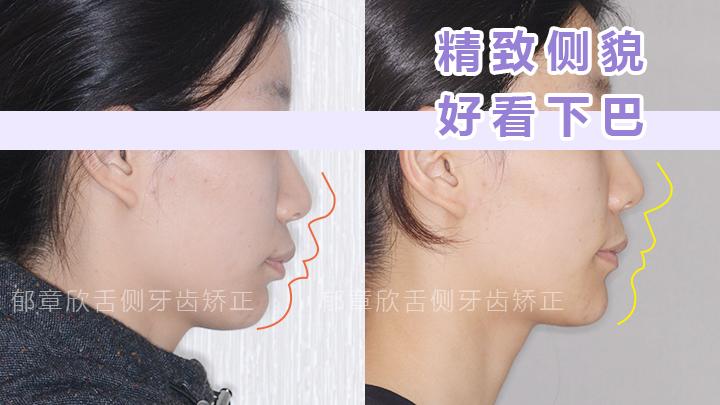 下巴后縮矯正方法詳解，下巴后縮矯正方法全面解析