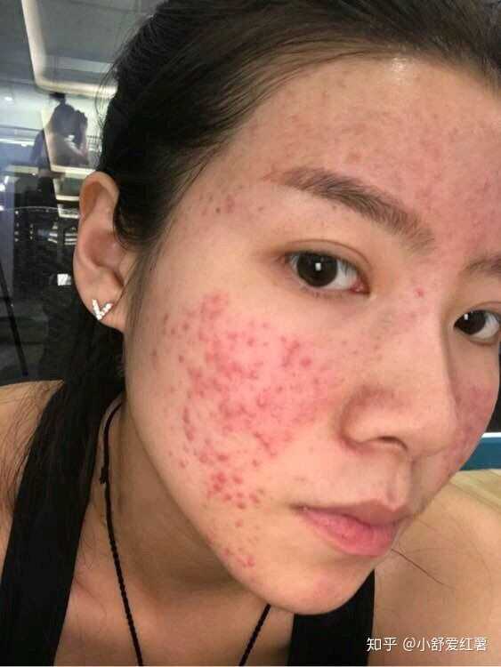 如何有效去除臉上的痘印——全方位指南，全方位指南，如何有效去除臉上痘印的方法