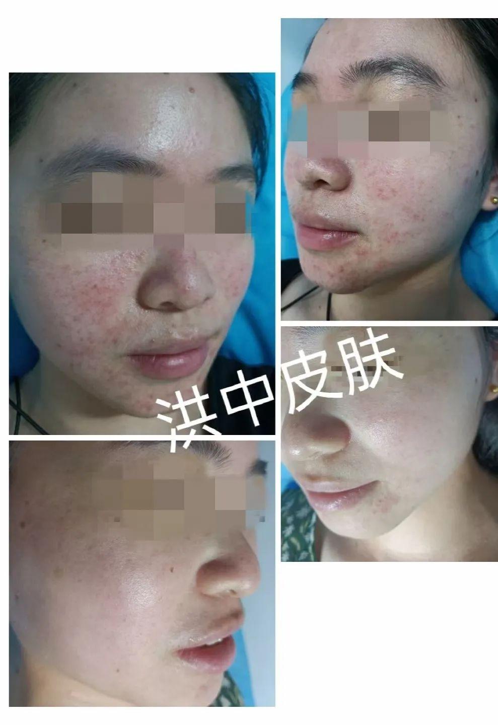 痤瘡圖片的樣子，深入了解痤瘡癥狀與表現(xiàn)，痤瘡癥狀深度解析，圖片展示痤瘡表現(xiàn)與形態(tài)