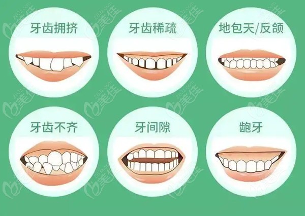 牙齒正畸費(fèi)用詳解，一般多少？，牙齒正畸費(fèi)用全面解析，了解一般價(jià)格及影響因素