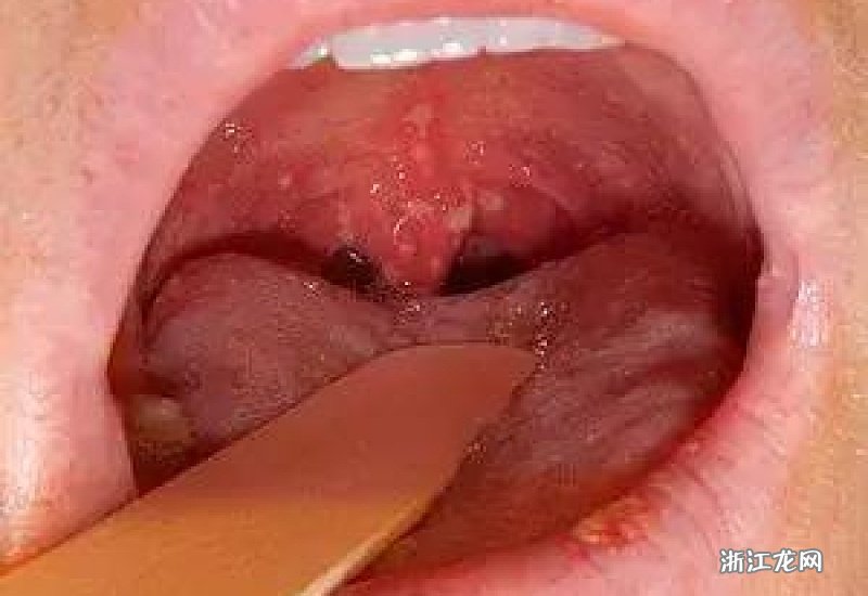 皰疹性咽峽炎五個(gè)分期詳解，皰疹性咽峽炎的五個(gè)分期詳解及特點(diǎn)解析