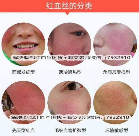 臉上出現(xiàn)紅血絲怎么治療，全面解析有效方法，臉上紅血絲全面解析與有效治療方法