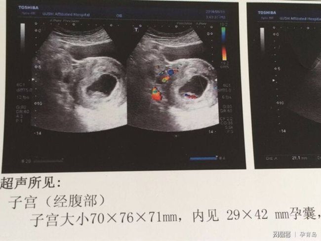 有卵黃囊基本就穩(wěn)了，早期妊娠的穩(wěn)固跡象與注意事項，早期妊娠的穩(wěn)固跡象，卵黃囊出現(xiàn)后的穩(wěn)定與注意事項