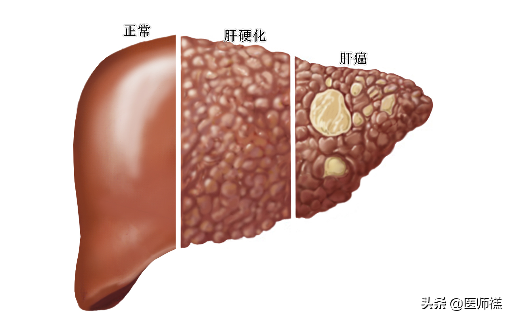 早期硬化的肝能治愈嗎，全面解析與希望，早期肝硬化能否治愈，全面解析與預(yù)后展望