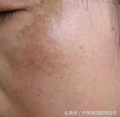 黃褐斑怎么治療最有效，全面解析最佳療法，全面解析黃褐斑最佳治療方法，最有效的療法選擇