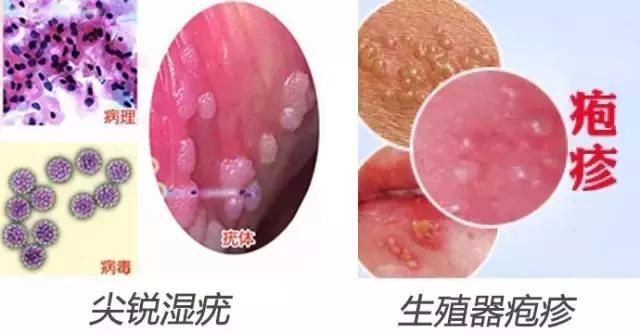 男性尖銳濕疣初期圖片及其相關(guān)解析，男性尖銳濕疣初期圖片及癥狀解析