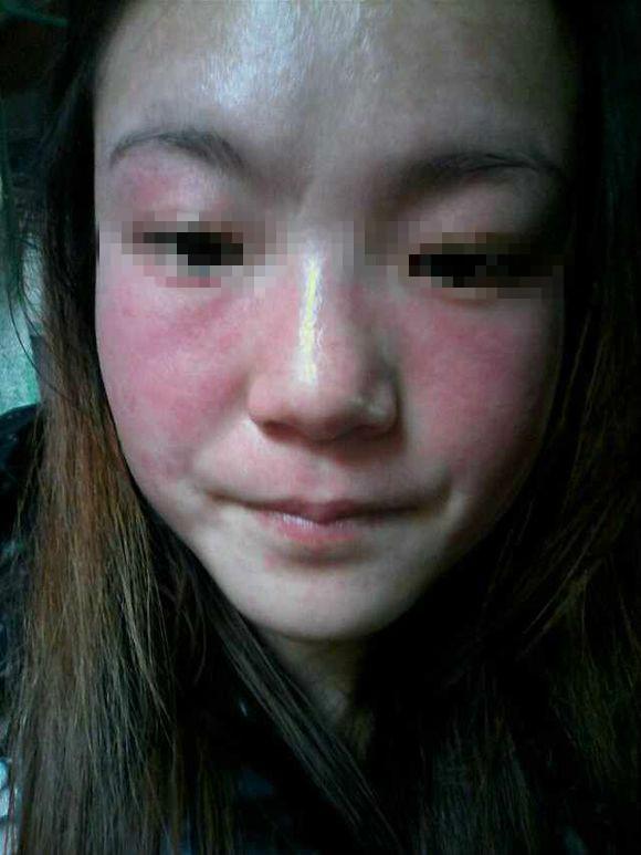 如何去掉黃褐斑的最好辦法，如何有效去除黃褐斑的方法探究