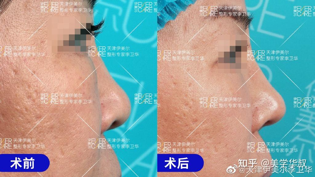 捏鼻三年，鼻頭變大——深度解析捏鼻子對(duì)鼻子的影響及應(yīng)對(duì)之策，捏鼻三年的影響，鼻頭變大原因解析與應(yīng)對(duì)之策