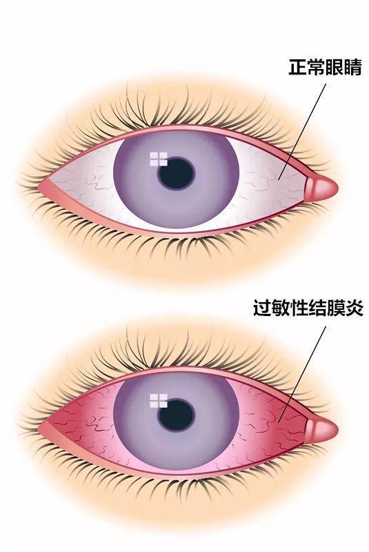 過敏性結(jié)膜炎，癥狀、原因及防治策略，過敏性結(jié)膜炎詳解，癥狀、成因與防治策略