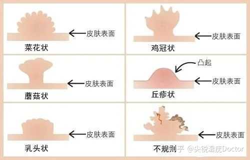 女性如何自己判斷真假尖銳濕疣？，女性如何自主辨別真假尖銳濕疣？