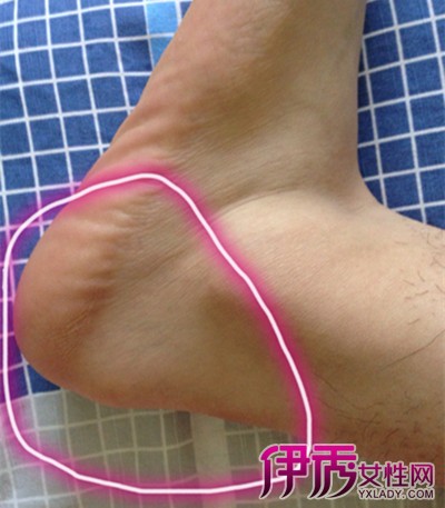 腳后跟疼的原因及治療方法，全面解析與應(yīng)對之道，腳后跟疼痛解析，成因、治療方法與應(yīng)對之道