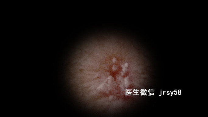尖銳濕疹，深入了解與治療建議，尖銳濕疹，深度解析與治療指南