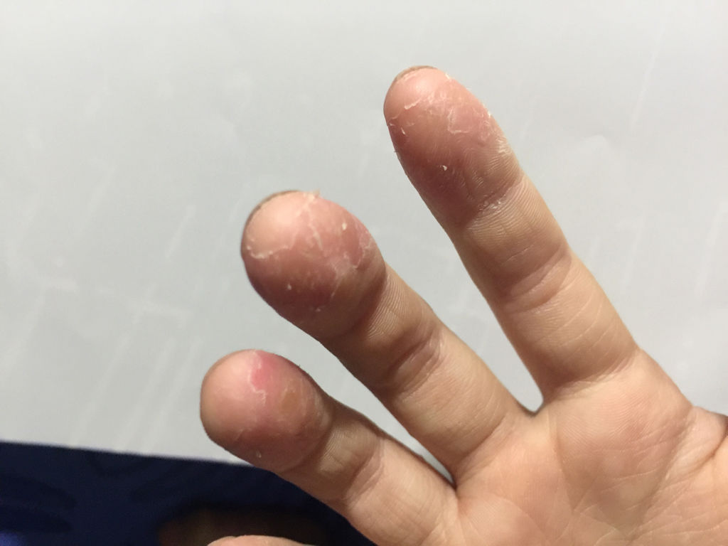 手指脫皮是什么原因，深度解析與應(yīng)對建議，手指脫皮深度解析，成因、應(yīng)對與建議