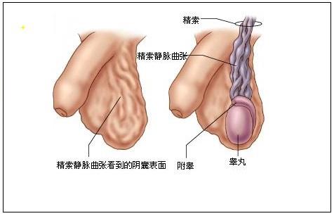 精索靜脈曲張，了解、預(yù)防與治療，精索靜脈曲張，全面解析了解、預(yù)防與治療策略