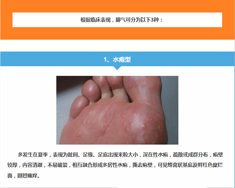 水泡型腳氣怎么治能除根——全面解析最佳治療方案，水泡型腳氣根治攻略，全面解析最佳治療方案