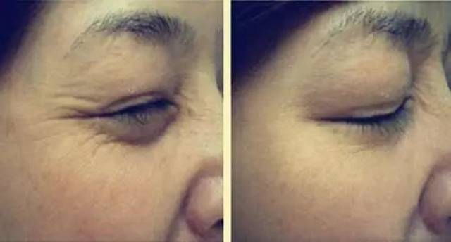 肉毒素除皺的副作用深度解析，肉毒素除皺副作用深度解析