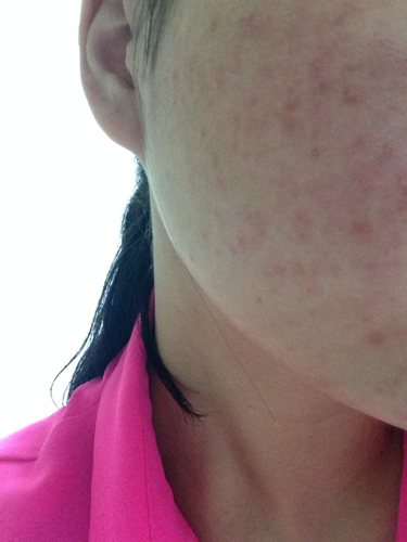 臉上突然長了好多紅色的痘痘，原因、治療與預(yù)防，臉部紅色痘痘，成因、治療與預(yù)防措施