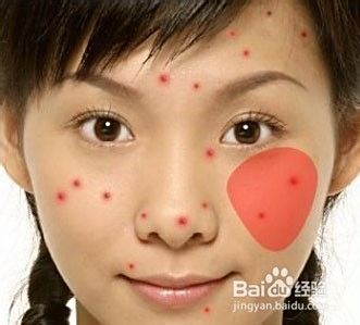 青春期長(zhǎng)痘痘了怎么消除，全面解析與應(yīng)對(duì)方法，青春期痘痘消除全面解析與應(yīng)對(duì)方法指南