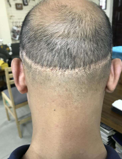 植發(fā)效果的持久性，能否長期維持與多種因素相關(guān)，植發(fā)效果的持久性與多種因素關(guān)聯(lián)，長期維持探討