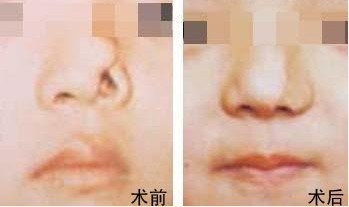 鼻整形手術(shù)費(fèi)用詳解，多少錢？一切因素告訴你！，鼻整形手術(shù)費(fèi)用全面解析，價(jià)格因素一網(wǎng)打盡！