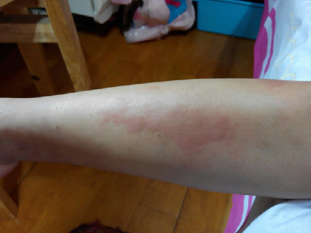 我用偏方成功治愈蕁麻疹，經(jīng)歷與分享，我用偏方成功治愈蕁麻疹，經(jīng)歷分享與治愈之路