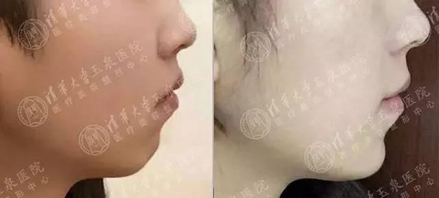 整容下頜骨大概需要多少錢——全面解析費(fèi)用因素與選擇策略，整容下頜骨費(fèi)用全面解析，費(fèi)用因素與選擇策略指南