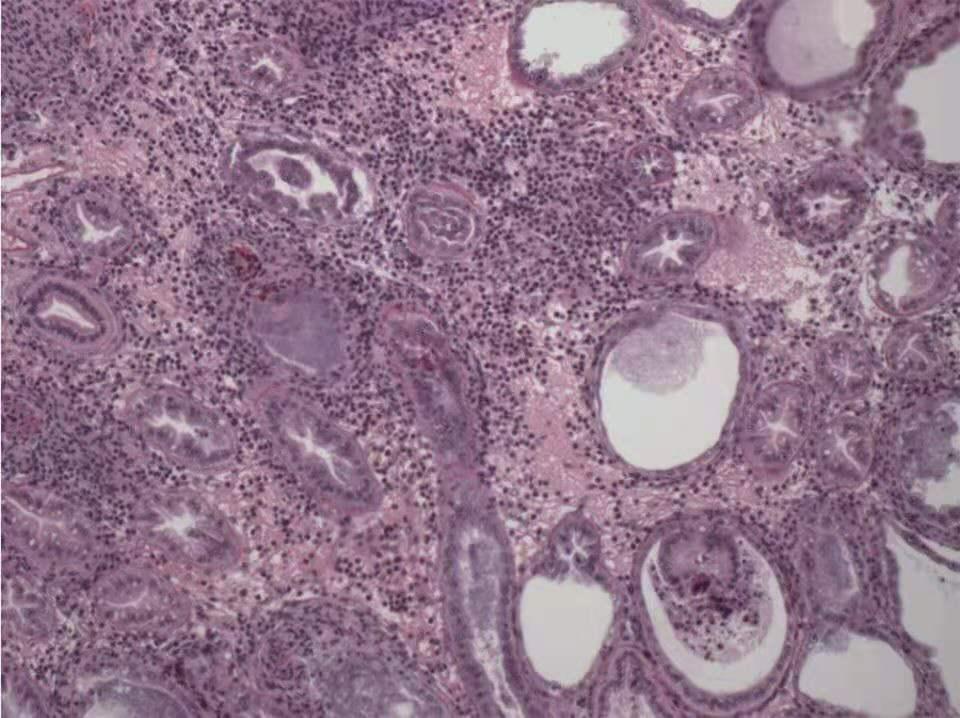 感染艾滋病的第一癥狀，了解、預防與應對，感染艾滋病的第一癥狀，了解、預防與應對策略