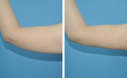 手臂抽脂價(jià)格一覽表——打造纖細(xì)玉臂的必備指南，手臂抽脂價(jià)格詳解，打造纖細(xì)玉臂的必備指南