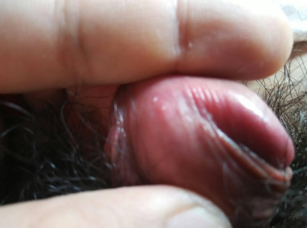 醋酸白疣體變白對照圖片，深入了解與識別，醋酸白疣體變白詳解，識別與對照圖片指南