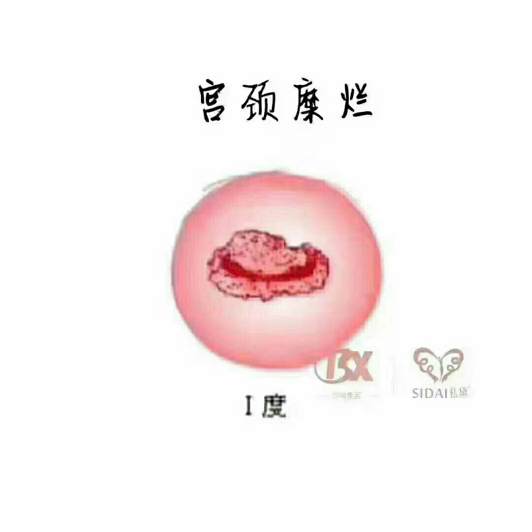 宮頸糜爛會(huì)自己恢復(fù)嗎？解讀宮頸健康與自我修復(fù)能力，宮頸糜爛的自我修復(fù)能力與宮頸健康解讀