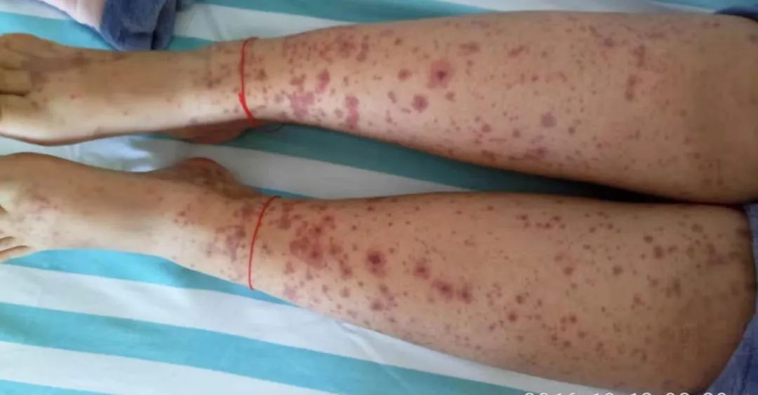 過敏性紫癜是終身病嗎？解析與理解，過敏性紫癜解析，是否為終身疾?。? class=