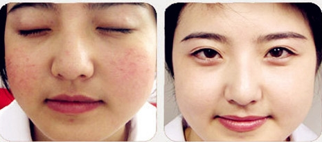 臉上紅血絲的治療方法，全面解析與應(yīng)對之道，全面解析與應(yīng)對之道，臉上紅血絲的治療方法