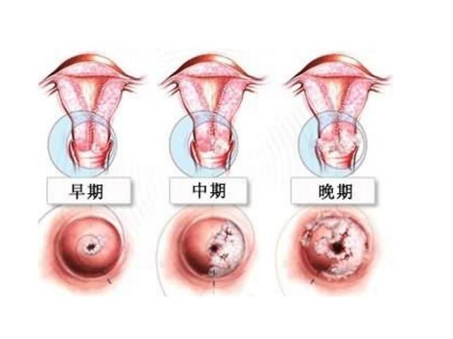 初期宮頸癌的征兆與應(yīng)對(duì)之策，初期宮頸癌的征兆及應(yīng)對(duì)策略