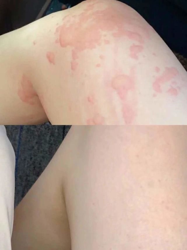 甲流癥狀最嚴(yán)重的幾天，全面解析與應(yīng)對建議，甲流最嚴(yán)重癥狀期解析及應(yīng)對建議