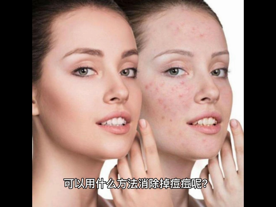 簡單有效的去臉上痘痘方法，簡單有效的臉部祛痘方法分享