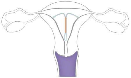 上環(huán)對(duì)身體有什么影響，全面解析與指導(dǎo)建議，全面解析與指導(dǎo)建議，上環(huán)對(duì)身體的影響及注意事項(xiàng)