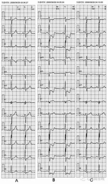 腦供血不足會(huì)自愈嗎？解析癥狀、原因及治療方法，腦供血不足詳解，癥狀、成因與治療方法，能否自愈？