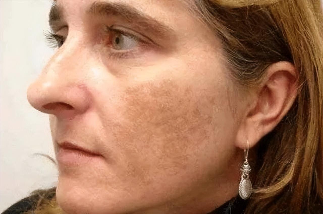 如何有效去除老年斑——全方位指南，全方位指南，如何有效去除老年斑