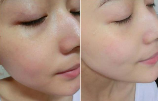 如何解決臉上出油太多的問題，解決臉部出油過多的方法技巧