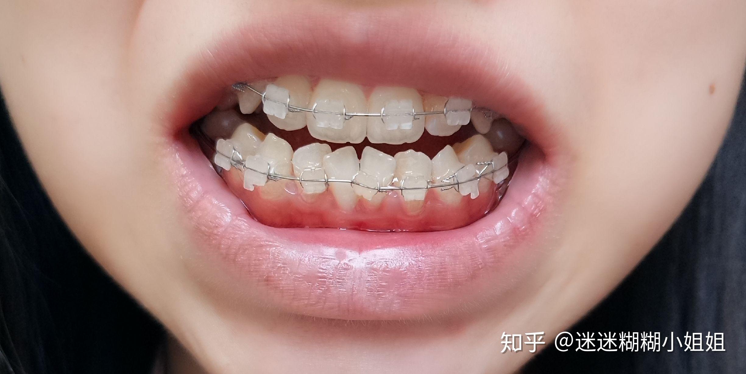 矯正牙齒的黃金時期與成年后的選擇，探討36歲矯正牙齒的必要性，矯正牙齒的黃金時期與成年后的選擇，探討矯正牙齒的必要性至36歲