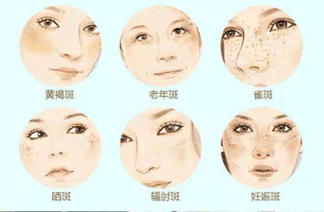 黃褐斑早期圖片，識別、預(yù)防與應(yīng)對，黃褐斑早期識別、預(yù)防與應(yīng)對策略及圖片解析