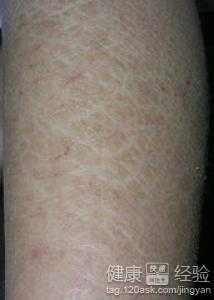 魚鱗皮膚病如何才能根治，全面解析與應(yīng)對策略，全面解析魚鱗皮膚病根治之道，應(yīng)對策略大揭秘