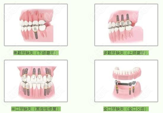種牙多少錢一顆牙價(jià)格表2023，全面解析種植牙費(fèi)用及影響因素，2023年種植牙價(jià)格表全面解析，費(fèi)用、影響因素一網(wǎng)打盡