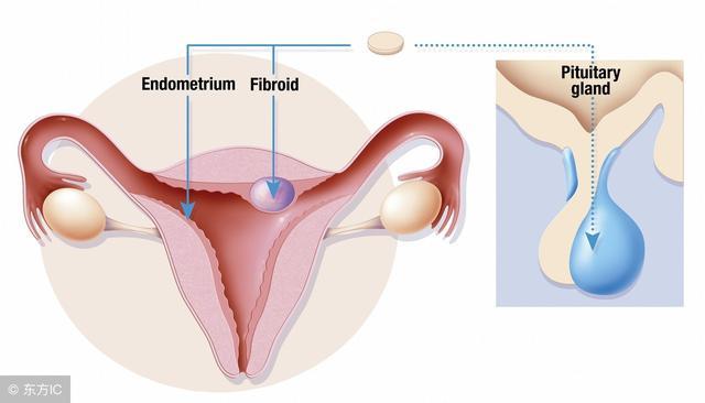 子宮肌瘤會自己消失嗎？解析子宮肌瘤的發(fā)展與消退可能性，子宮肌瘤的發(fā)展與消退可能性解析，能否自行消失？