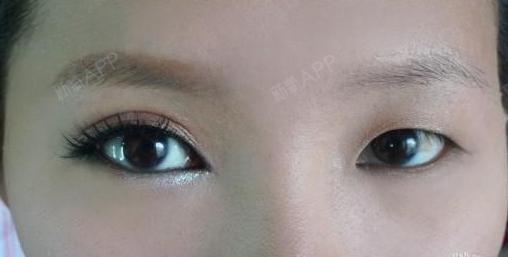 如何糾正眼皮一單一雙，專業(yè)指南與實用建議，眼皮一單一雙如何糾正？專業(yè)指南與實用建議全解析