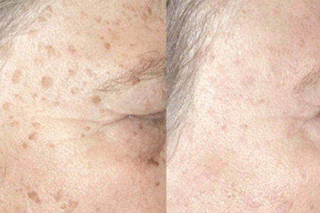 怎樣消除老年斑——全面解析與應(yīng)對策略，全面解析，消除老年斑的應(yīng)對策略