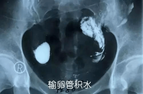 輸卵管造影費用詳解，多少錢及大概價格范圍，輸卵管造影費用解析，價格范圍及詳細(xì)費用探討