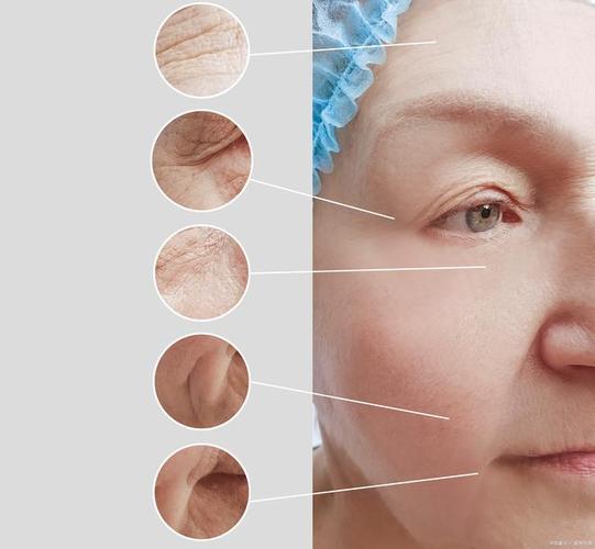 激光去皺紋，效果維持時間與多重因素解析，激光去皺紋，效果維持時間與多重因素詳解