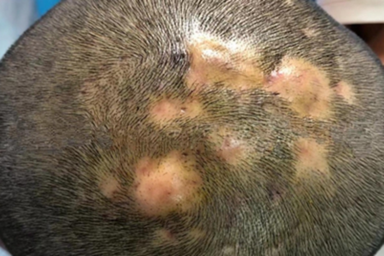 毛囊炎硬疙瘩圖片，了解、識(shí)別與治療，毛囊炎硬疙瘩詳解，識(shí)別圖片、了解與治療